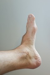 Left foot following high energy impact and rotation, Lisfranc joint midfoot injury, fractured...