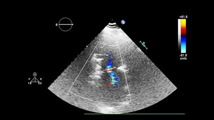Screen of echocardiography (ultrasound) machine.