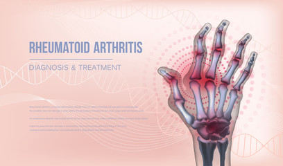 Rheumatoid arthritis banner hand joints deformation.