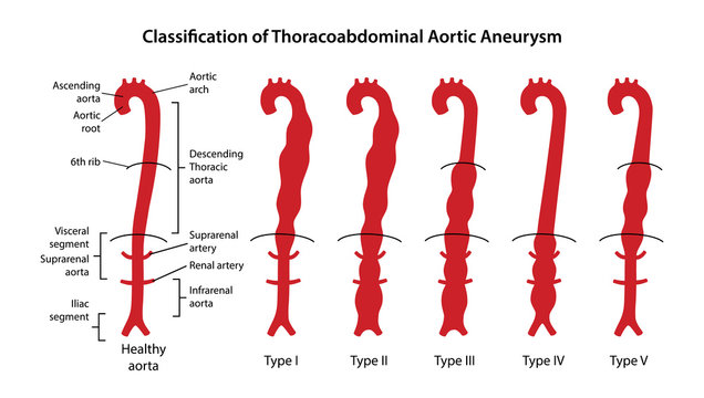 Classification Of Thoracoabdominal Aortic Aneurysms. Healthy Aorta With Main Parts Labeled And Aorta With Various Types Of Thoracoabdominal Aneurysm. Vector Illustration In Flat Style