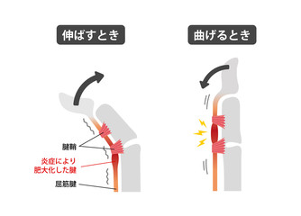 ばね指・バネ指 (弾撥指) / 原因と症状　骨格解剖図イラスト / 日本語