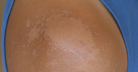 Fototapeta premium Sunburned skin, peeling skin from a sunburn