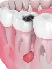 3d render of jaw with tooth cavity and cyst