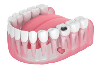 3d render of jaw with tooth cavity and cyst