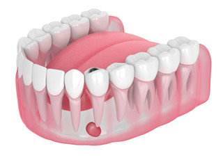 3d render of jaw with tooth cavity and cyst