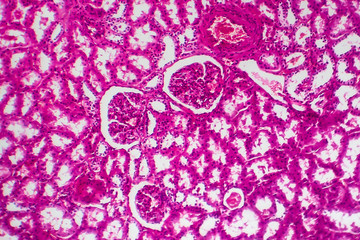 Tubular atrophy, light micrograph, photo under microscope