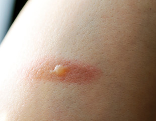 Fototapeta premium Close-up of a burn with a blister on the skin of a hand