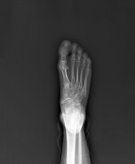 normal radiography of the foot, medical diagnostics, traumatology and orthopedics, rheumatology