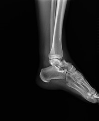 Obraz premium normal radiography of the ankle joint in lateral projection, traumatology and orthopedics, rheumatology