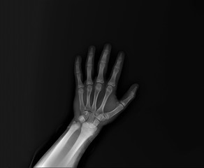 normal radiography of the shoulder joint and ribs in direct projection, Traumatology and orthopedics, traumatology, sports injury