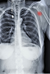 radiography of the shoulder joint in direct projection with a fracture of the shoulder blade, Traumatology and orthopedics, traumatology, sports injury