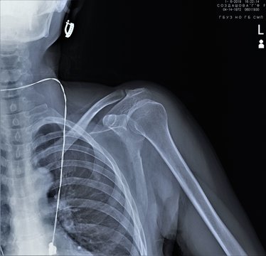 normal radiography of the shoulder joint in direct projection, traumatology and orthopedics, traumatology
