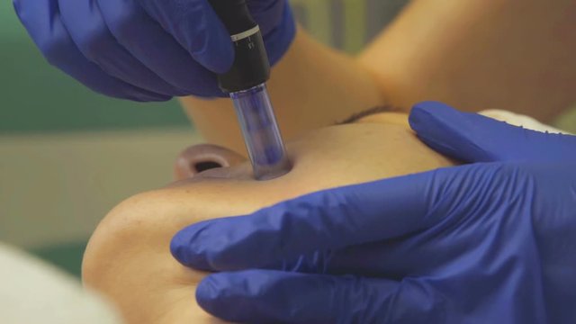 Cosmetologist making mesotherapy injection. Microneedle mesotherapy. Close up, slow motion