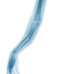 X-ray image of broken forearm, show ulnar and radius fractures