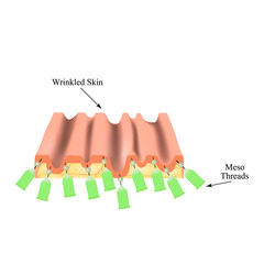 Mesotherapy Threads Lifting. threads for facelift. The structure of the skin. Wrinkles. Infographics. Vector illustration on isolated background.