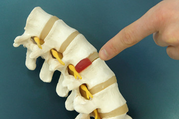 Finger pointing at spinal hernia - model
