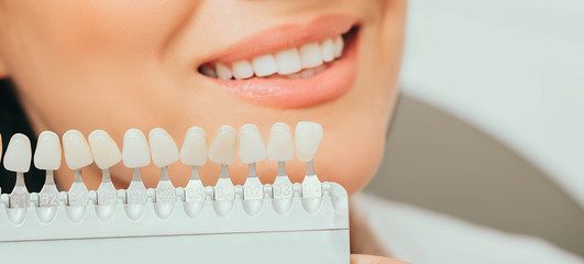 teeth palette with different shades of teeth near female smiling. Stomatology, whitening teeth, tooth implant