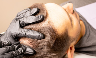 Male trichopigmentation service. Young man laying on the back on the esthetician table. Master hands in a black gloves holding the permanent makeup machine with the needle and touching mans hair.