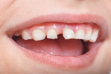 Baby tooth, close-up of the tooth that falls macro shot