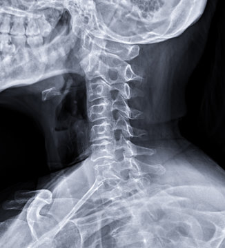X-ray C-spine or x-ray image of Cervical spine oblique view for diagnostic intervertebral disc herniation.