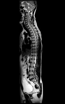 MRI of whole spine  T2W sagittal  plane for diagnostic Spinal Cord Compression.