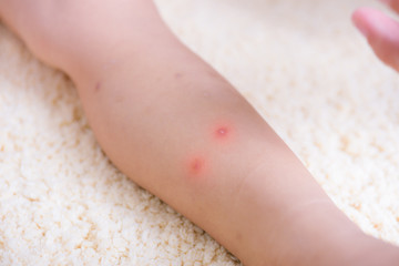 Kid have insect bites, mother applying antiallergic cream children knee
