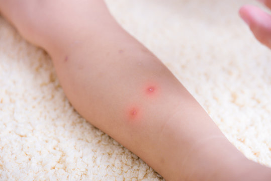 Kid have insect bites, mother applying antiallergic cream children knee