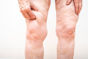A senior woman holding, pulling a lot of excess loose skin on legs after weight loss, gastric...