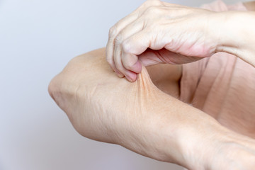 A senior elderly woman holding, pulling the skin on her arm with bad turgor, exces loose skin
