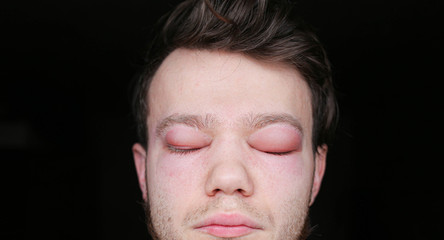 Naklejka premium two inflamed red blood eyes of a man affected by conjunctivitis or after the flu, cold or allergy.
