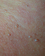 Impetigo occurs on the skin.