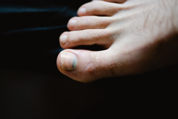A mans foot with the large toe broken in a sporting injury with a discoloured/black toe nail.