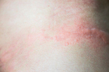 Fototapeta premium urticaria on skin. rashes, of which urticaria and toxic erythema are the most common.