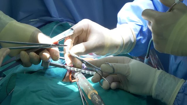 chirurghi in sala operatoria durante un'operazione al cuore