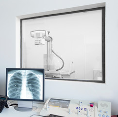 Close up of chest X-ray on monitor