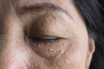 Closeup of wrinkles in Asian woman face skin in deep layers. Skin repair and treatment concept for elderly and aged people. Healthcare, medical, eyes lift, face lifting and aesthetic concept