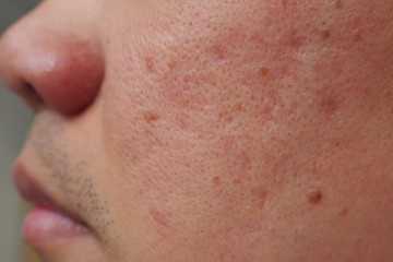 Closeup of red skin with acne moles and pores on the face of a young Asian man Health medical...