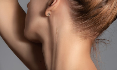 Woman with surgery scar at her neck. - obrazy, fototapety, plakaty