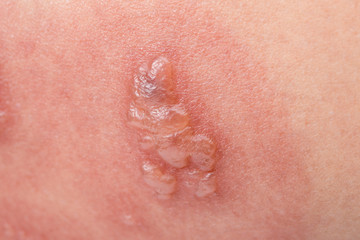 Fototapeta premium Shingles, Zoster or Herpes Zoster symptoms on arm