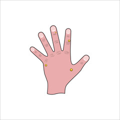 Obraz premium Wart removal medical illustration, human left hand affected by papilloma virus