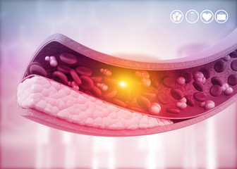 Atherosclerosis, Cholesterol plaque in artery. 3d illustration.