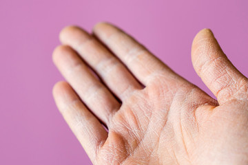 Women's hands  close-up, dry skin