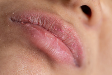 Backgrounds of Dry lips in the clinic.