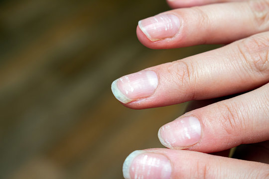 The Black Line on Nail: Is It Splinter Hemorrhages | Credihealth