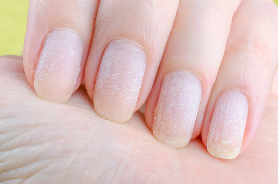 Damaged Nails After Removing Modern Gel Nail Polish