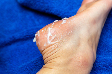 applying cream on the feet sole for the treatment of corn, callus, callosity, cracks, softening the skin, cosmetic procedures