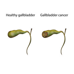 Gallbladder cancer. Healthy, tumor. Oncology. Medical anatomy illustration.