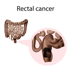 Rectal cancer. Tumor. Oncology. Medical anatomy illustration.