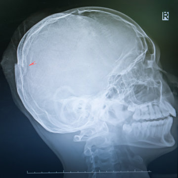 x ray film of a skull of a patient suffering from traumatic injury showing broken fractured skull bone