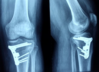 osteotomy